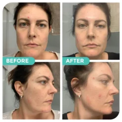 Avocado & Hemp Green Clay Mask By Hemp Co Australia 15 Avocado & Hemp Green Clay Mask By Hemp Co Australia -Skin Care Specialty Store BeforeandAfterpics2 720x bbcd5532 6afb 432c af5d ce5c5e21a7fc