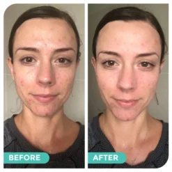 Avocado & Hemp Green Clay Mask By Hemp Co Australia 16 Avocado & Hemp Green Clay Mask By Hemp Co Australia -Skin Care Specialty Store BeforeandAfterpics3 720x 17faa8cf cda5 40da a277 4abbcb165d7e