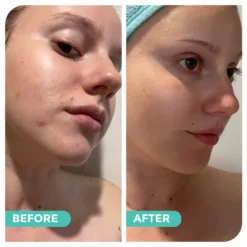 Avocado & Hemp Green Clay Mask By Hemp Co Australia 19 Avocado & Hemp Green Clay Mask By Hemp Co Australia -Skin Care Specialty Store BeforeandAfterpics6 720x 98c68668 f3c4 403f abcb b59d9b0e275e