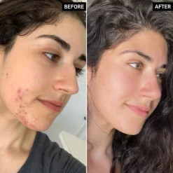 Targeted Blemish Duo -Skin Care Specialty Store SUCCINICACID2 97129619 df76 4d06 9c09 98f7e337509c